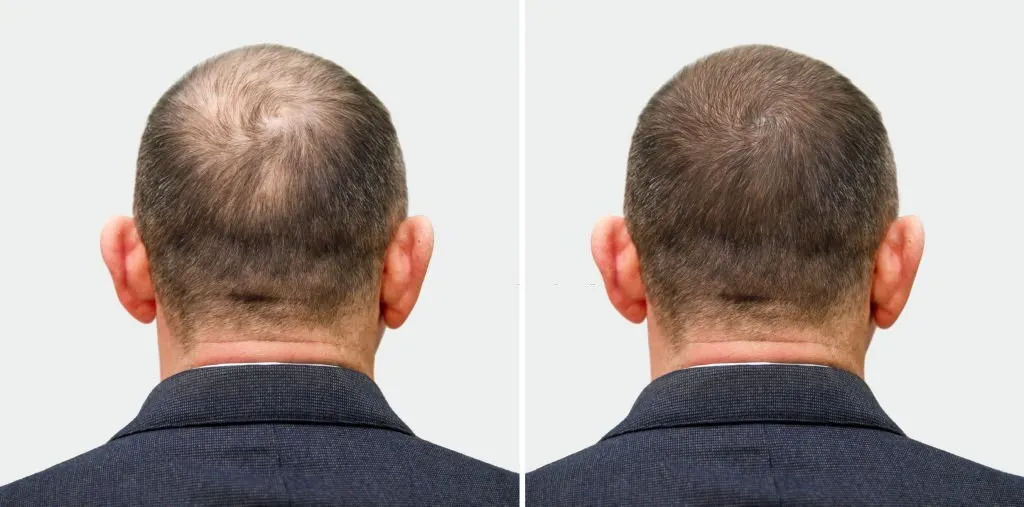 Hair Transplant Before and After Results